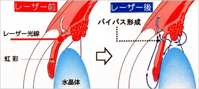 レーザーによる虹彩のバイパス形成