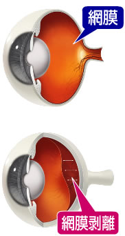 網膜／網膜剥離