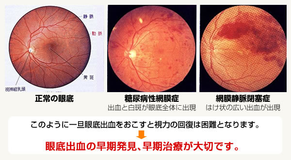 一旦眼底出血をおこすと視力の回復は困難となります。眼底出血の早期発見､早期治療が大切です。
